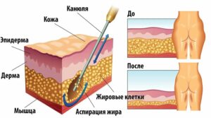 chto takoe liposakciya