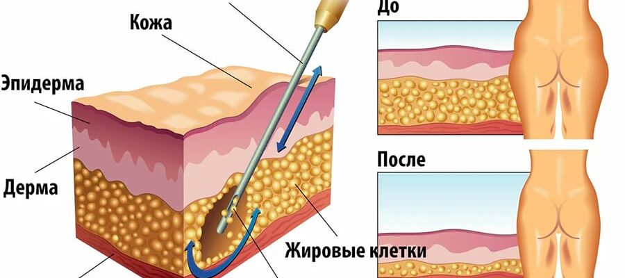 chto takoe liposakciya